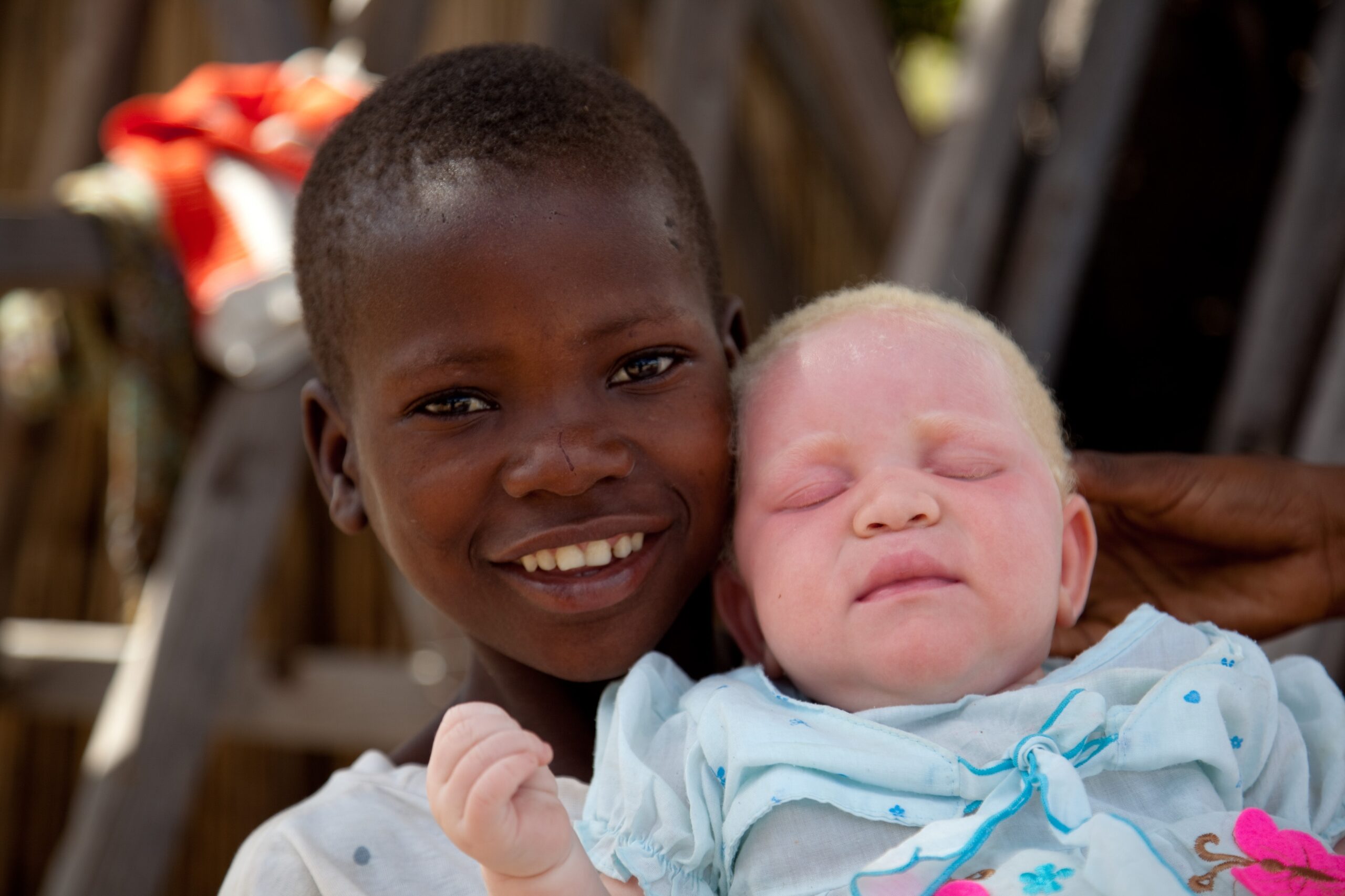 How the albino myth is endangering Tanzanian children
